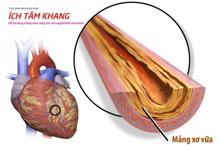 Bệnh mạch vành đặc trưng bởi sự hình thành và phát triển mảng xơ vữa trong lòng mạch 